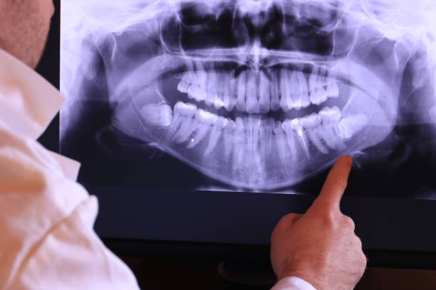 Best Emergency Dentist for Lost Fillings or Crowns in North Haledon, NJ